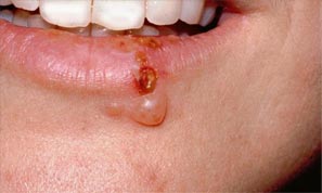 Herpes-Infected Woman Wins $6.7 Million in Court