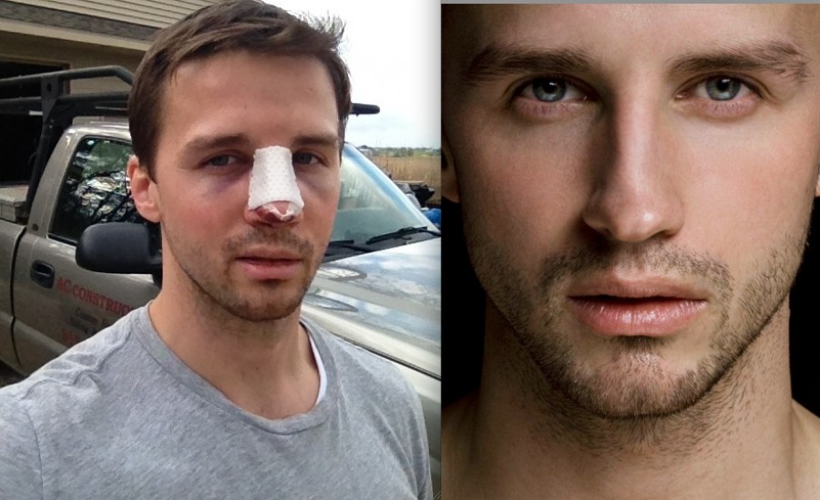 SHOCKING Before And After Photos Of Gay Porn Star Turned Male Escort Simon  Dexter's Nose Job - TheSword.com
